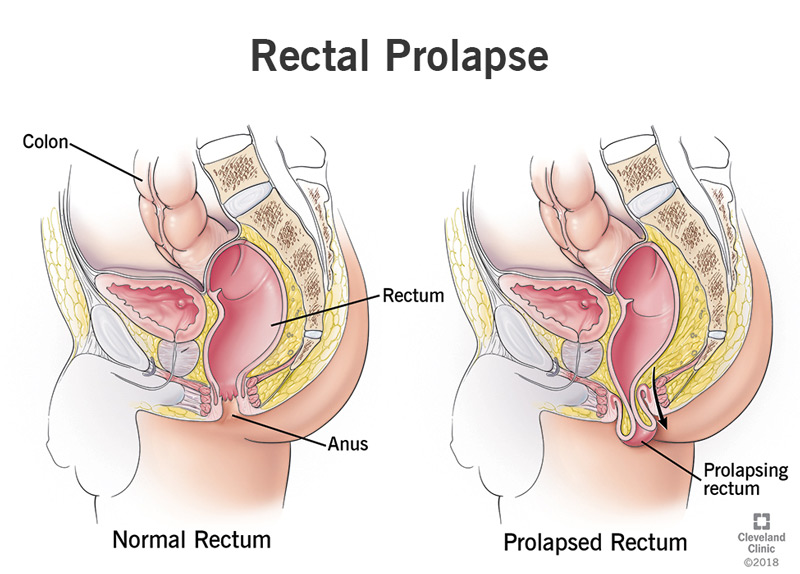 A prolapsed rectum slips down into the anal canal, and sometimes pokes out of the other side.