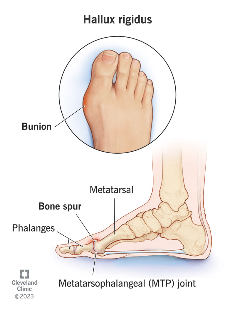 An illustration of a bunion (hallux rigidus) on a person's foot