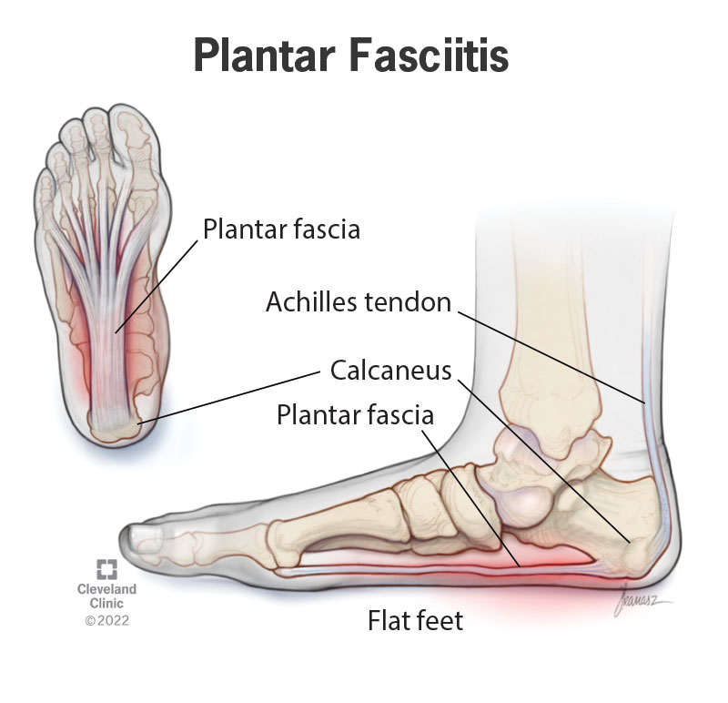 An illustration of plantar fasciitis in a person with flat feet