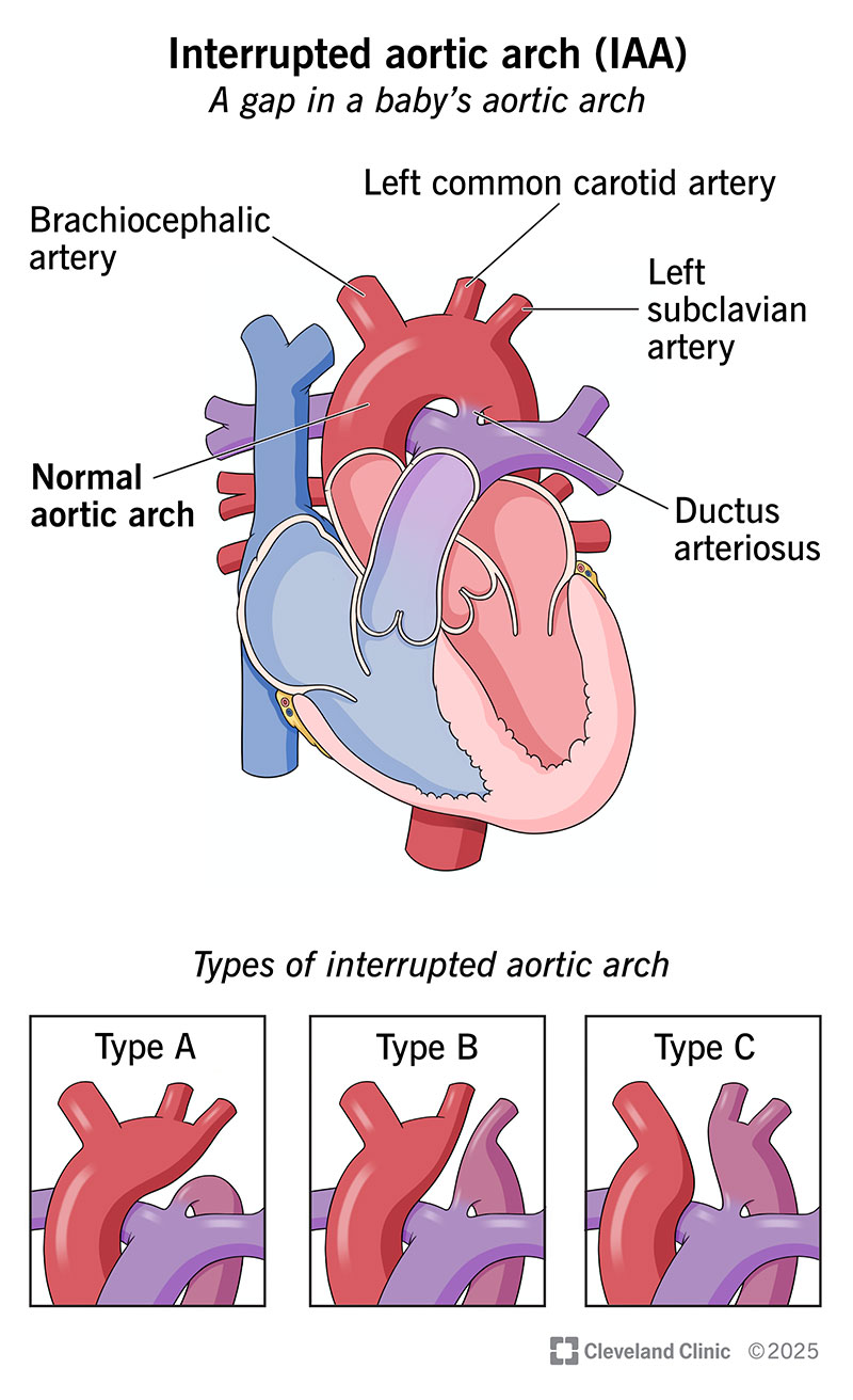 Interrupted aortic arch is a gap in the aorta that disrupts blood flow. The gap can form in different areas of the arch