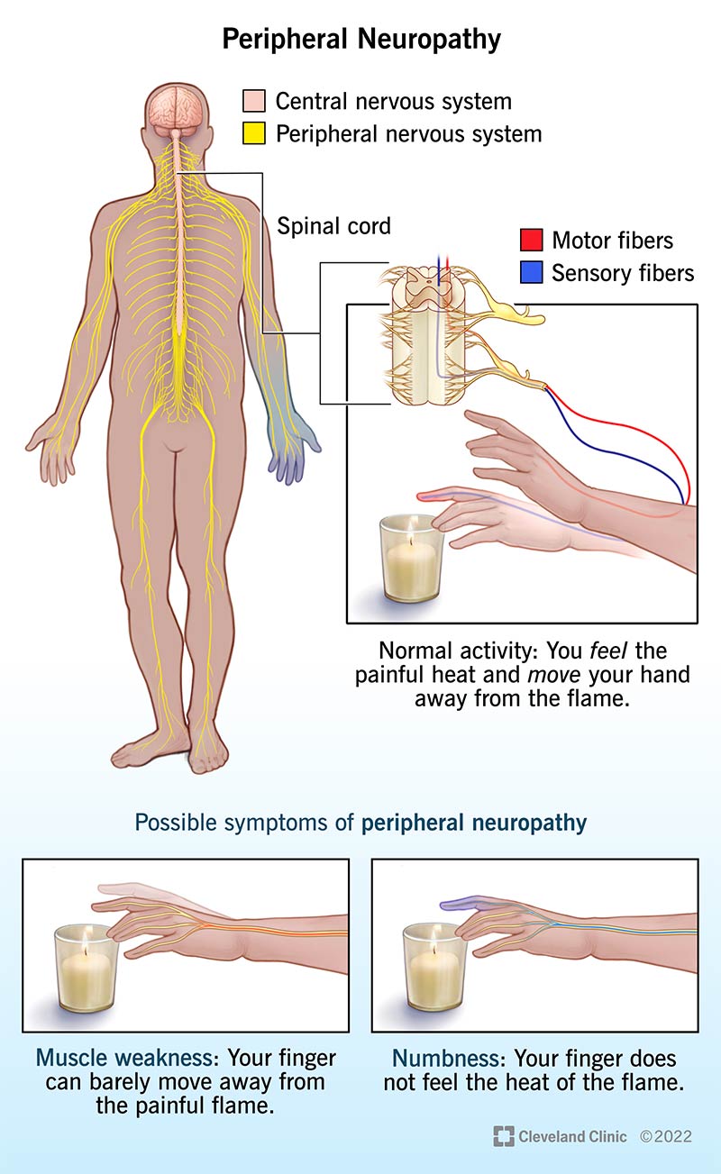 Peripheral neuropathy conditions affect the peripheral nerves, which are nerves outside your brain and spinal cord.