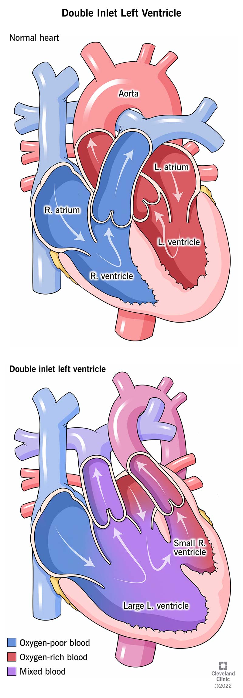 With double inlet left ventricle, both of your baby’s atria supply blood to their left ventricle, resulting in oxygen-rich blood and oxygen-poor blood combining.