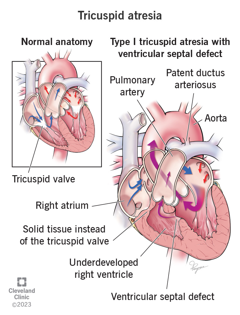 Normal heart anatomy compared to a heart with Type 1 tricuspid atresia.