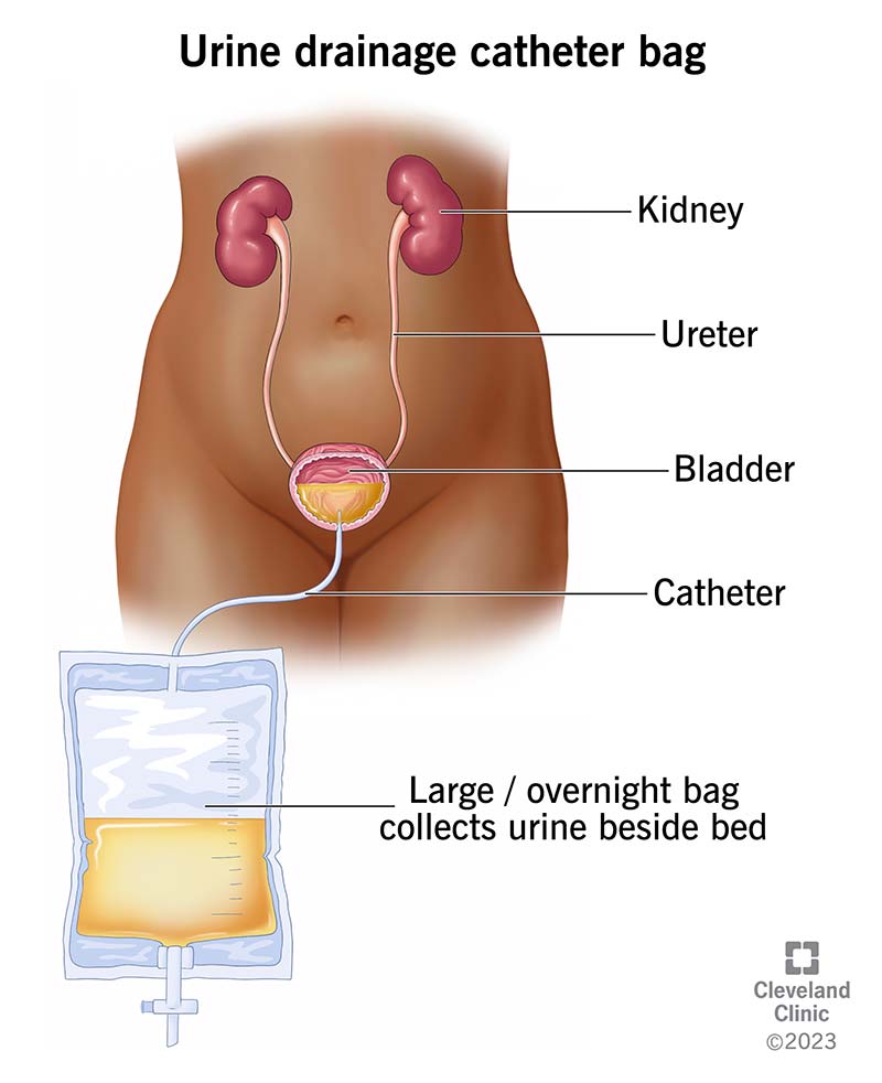 Bladder full of pee drains through a catheter and into a large catheter bag