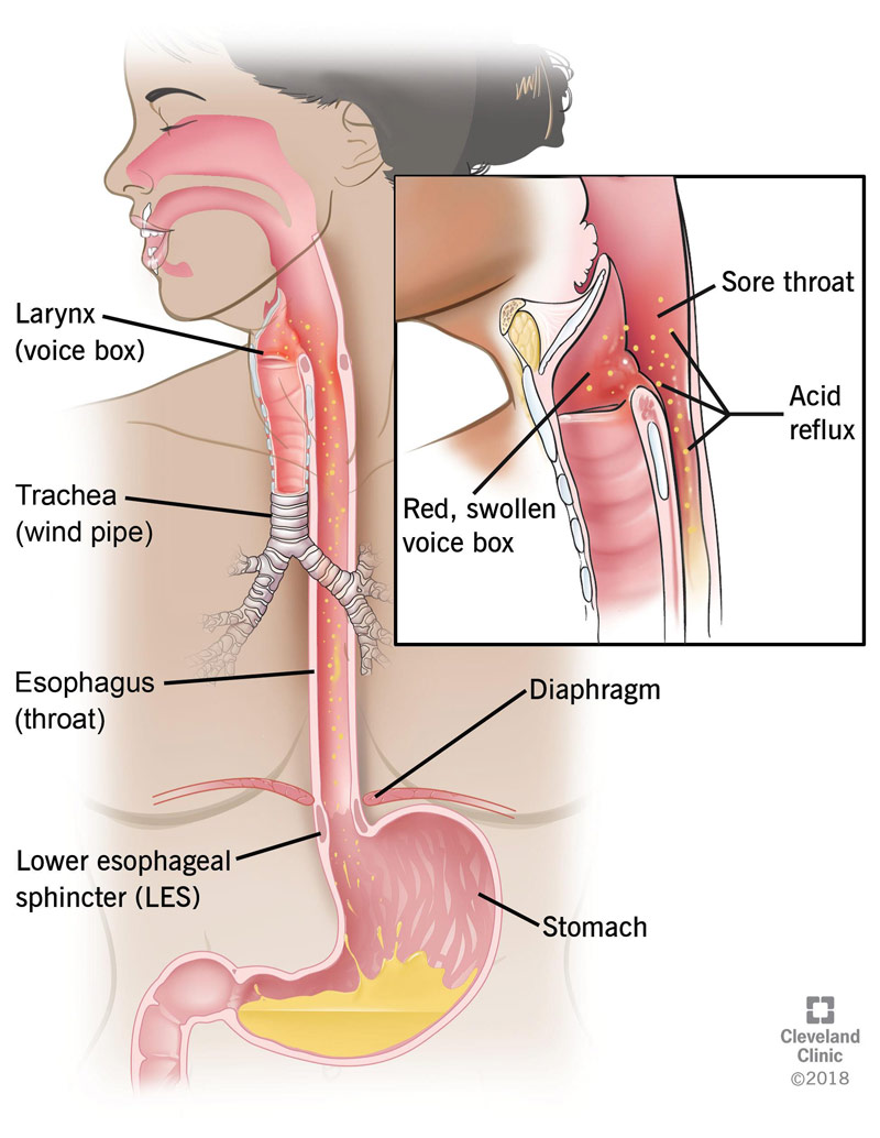 Acid made in the stomach travels up the esophagus (swallowing tube) and gets to the throat.