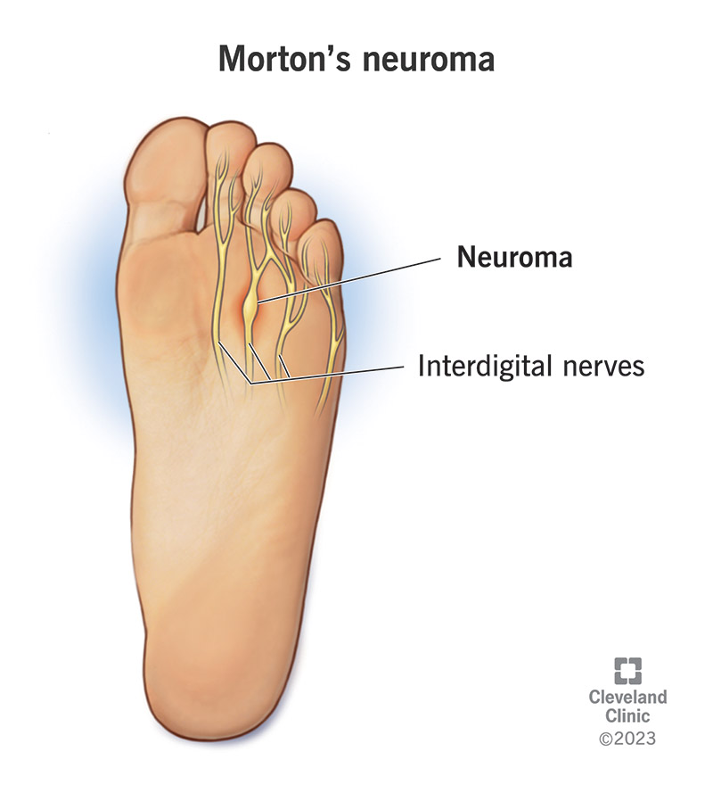 An illustration of a Morton's neuroma on a nerve on a person's foot.
