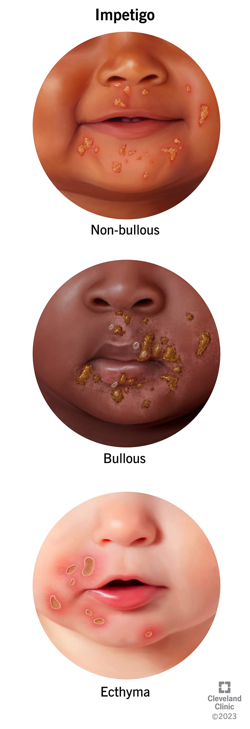 The three stages of impetigo: non-bullous, bullous and ecthyma.