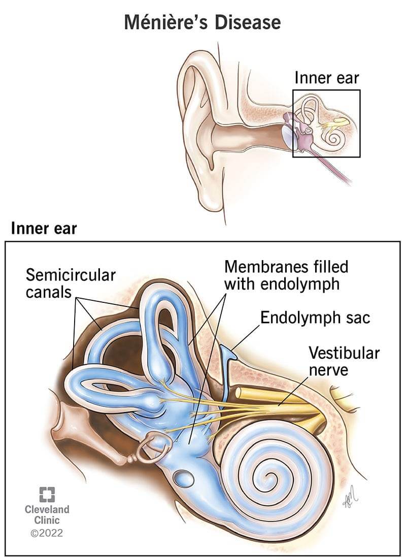 Top – Location of inner ear structure within ear. Lower – Insert close up of inner ear structure including vestibular nerve (lower right), endolymph sac (middle right), membranes filled with endolymph (upper right) and semicircular canals (upper left).