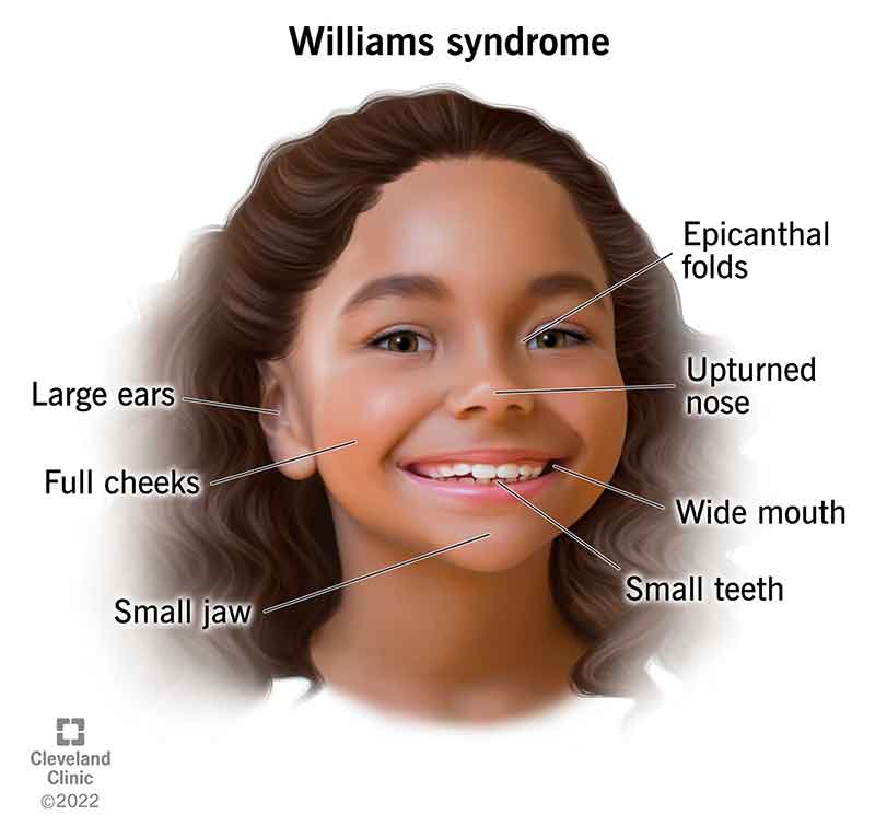 Williams syndrome causes symptoms that affect many parts of your child’s body. Children diagnosed with this condition have distinct facial characteristics that include vertical skin folds that cover the inner corner of their eyes (epicanthal folds), large ears, an upturned nose, full cheeks, a wide mouth, a small jaw and small teeth.