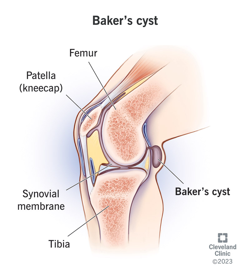 A Baker’s cyst is a small, fluid-filled bump that forms on the back of your knee.