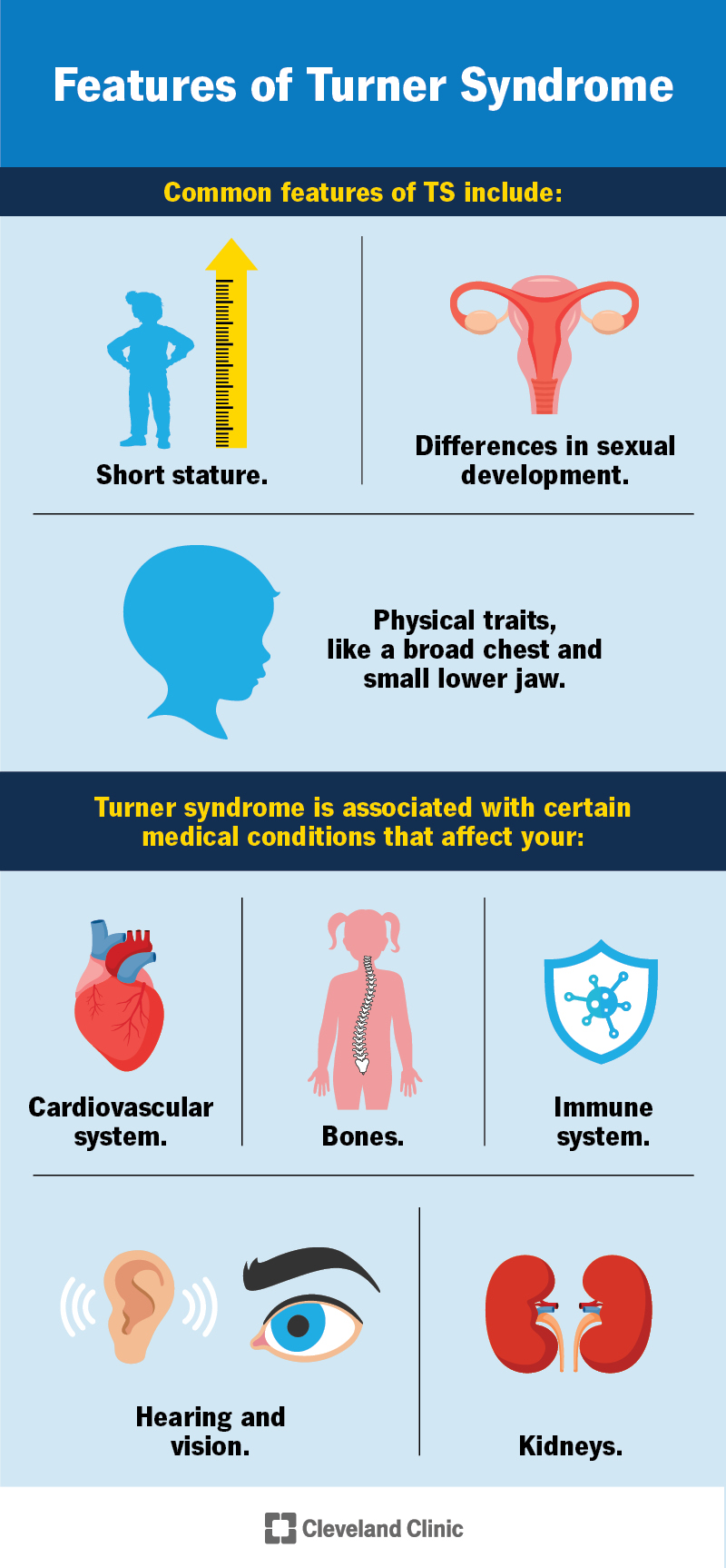Common features of Turner syndrome include short stature, differences in sexual development and certain physical traits.