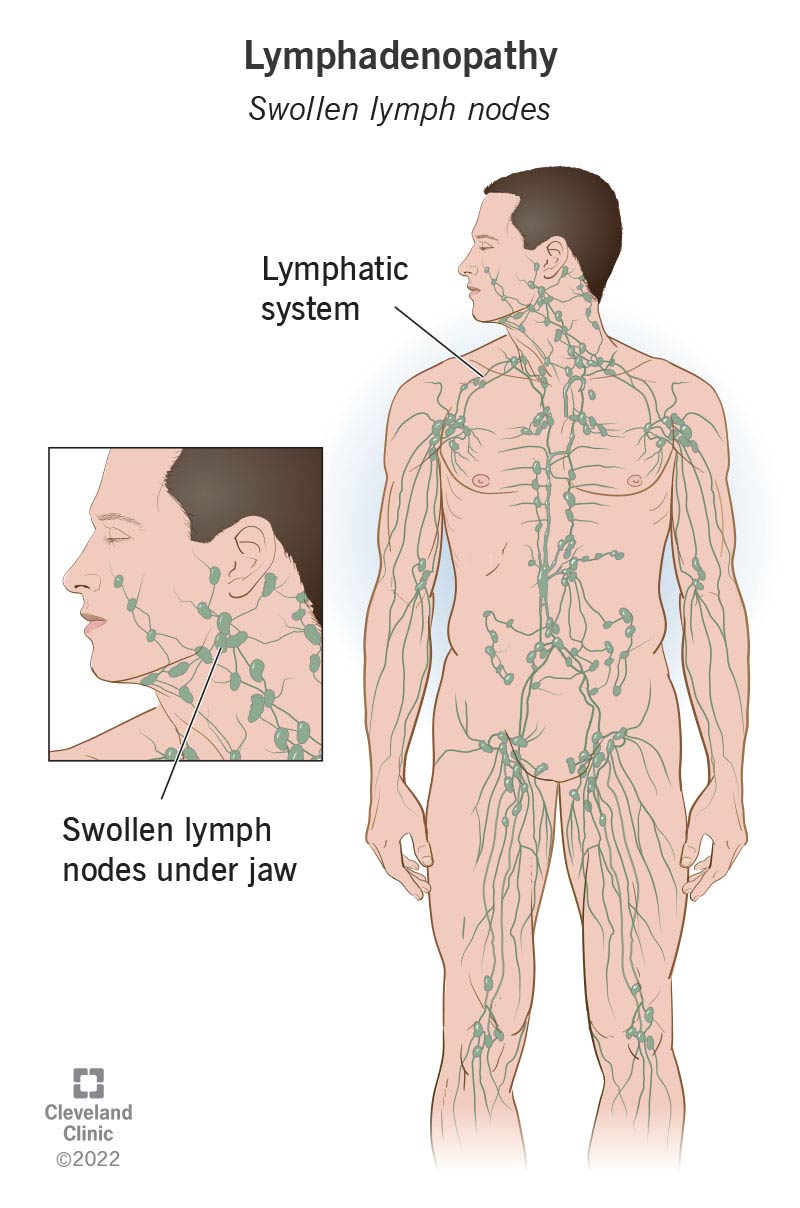 swollen tonsils with white spots and swollen glands