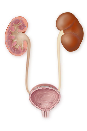 Hématurie Sang dans l'urine