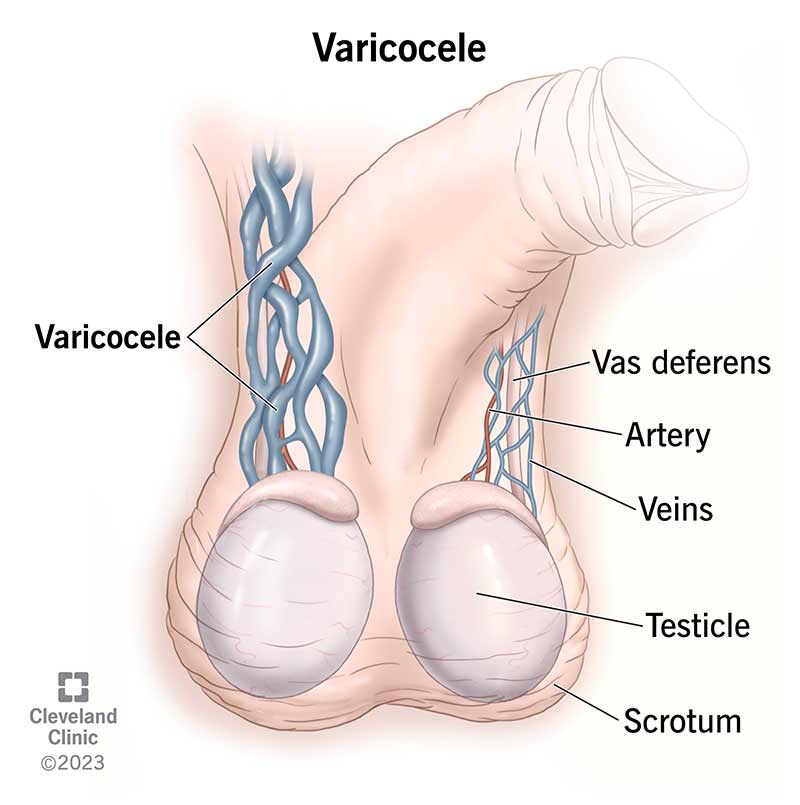 Varicocele: Causes, Symptoms, Diagnosis & Treatment