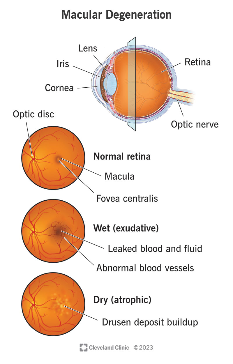 Dry Macular Degeneration   15246 Macular Degeneration