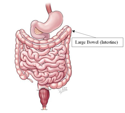 Large Bowel (Intestinal) Obstruction