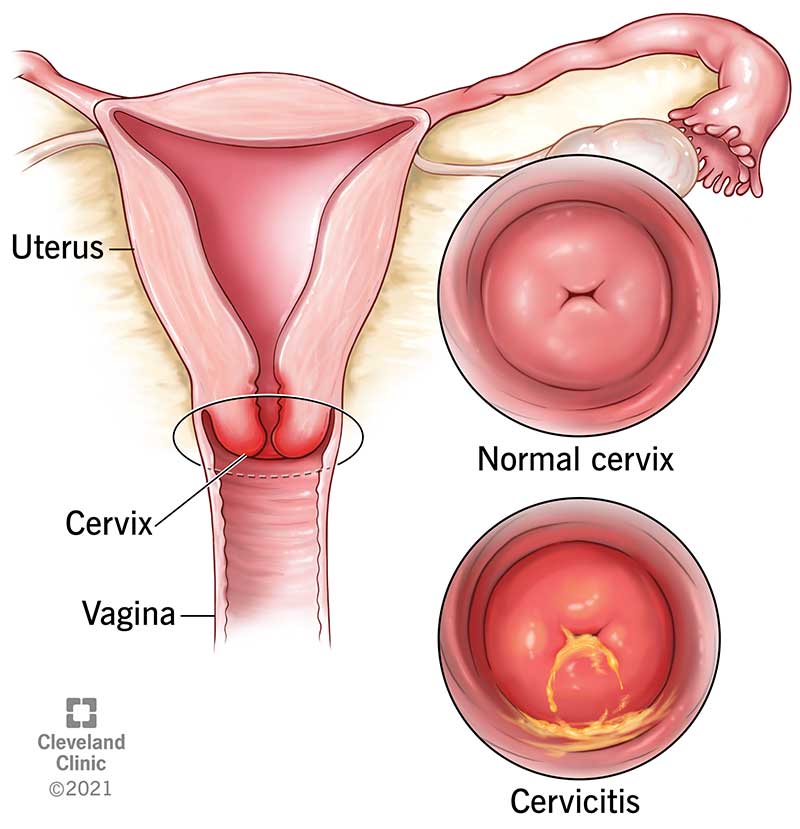 Normal cervix vs cervix with cervicitis.