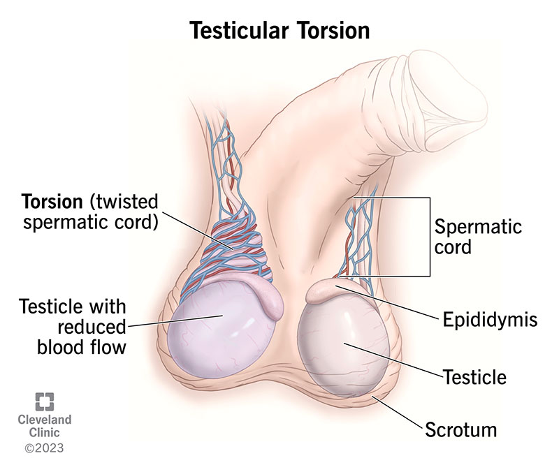A testicular torsion is a painful twisting of a spermatic cord in your scrotum.