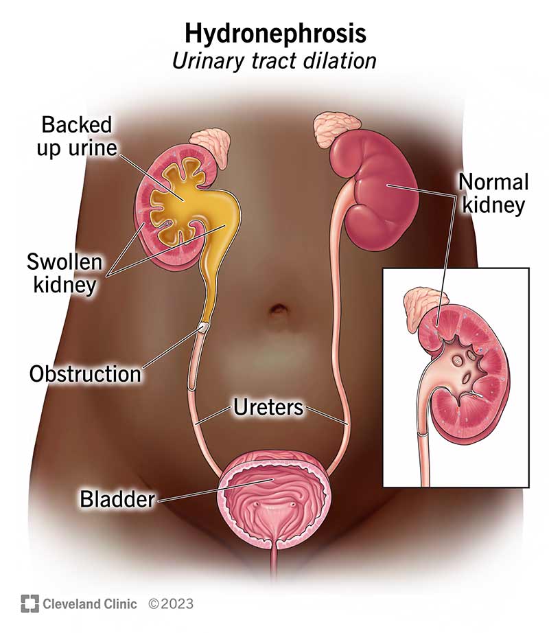 Urinary tract anatomy showing an enlarged kidney with pee backing up into it.