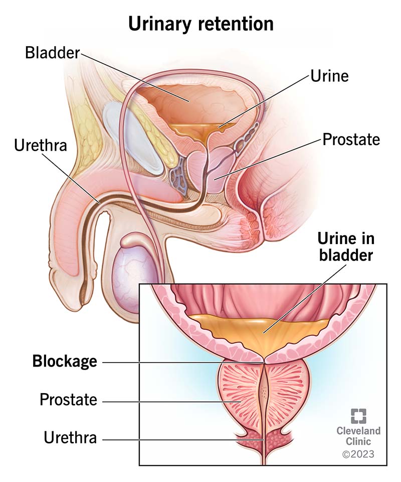 A blockage at the bottom of a bladder causes urine to back up into the bladder and not empty during urination.