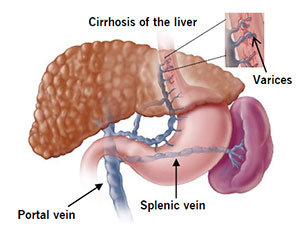 varicoza stomac