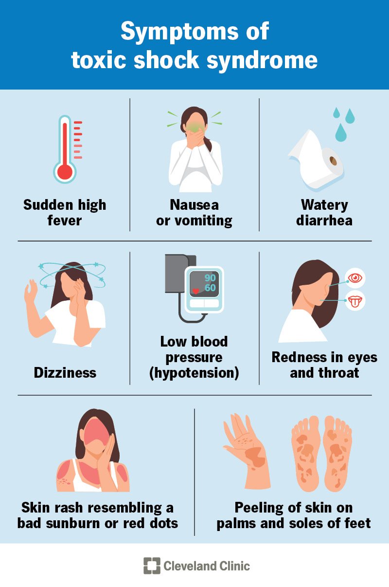 Symptoms of toxic shock syndrome are sudden high fever, dizziness and low blood pressure
