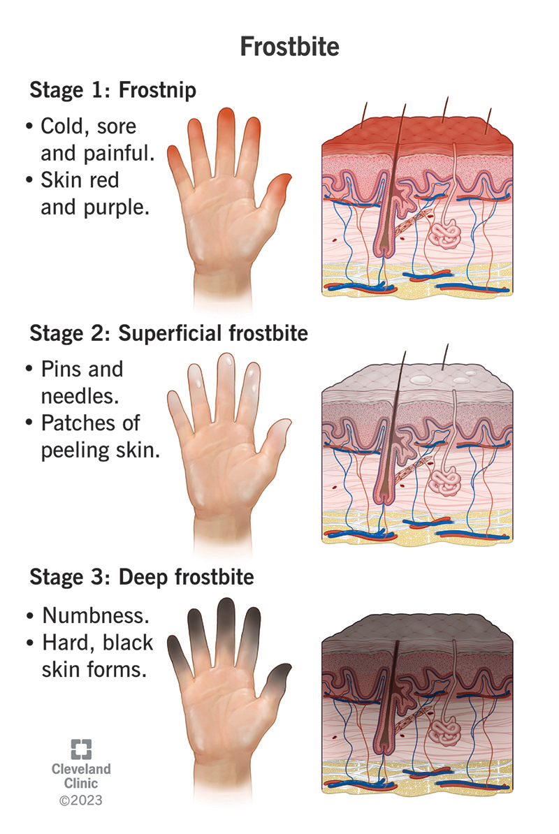 Three hand illustrations with descriptions of the three stages of frostbite.