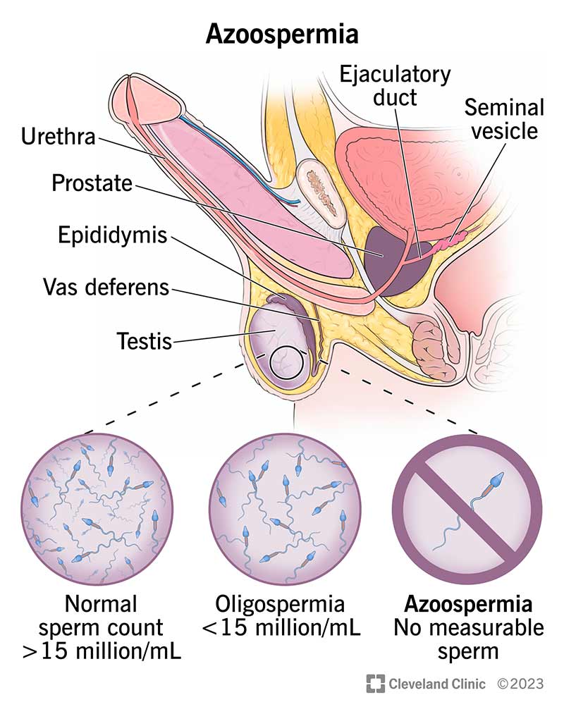 Azoospermia is no measurable sperm in a person’s semen.