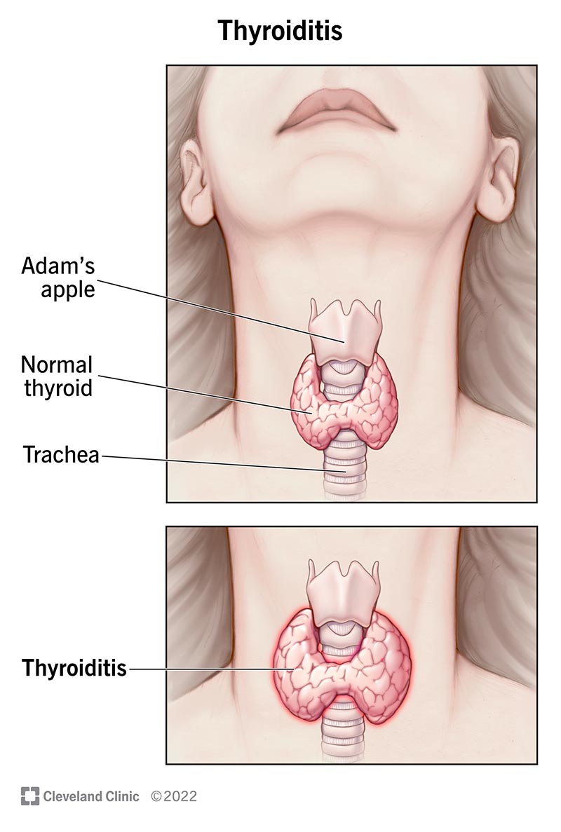 Illustration showing a normal thyroid, which wraps around the trachea below the Adam's apple, and thyroiditis as an enlarged thyroid.