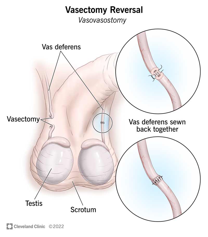 During a vasectomy reversal, scar tissue is removed and your vas deferens are sewn back together.