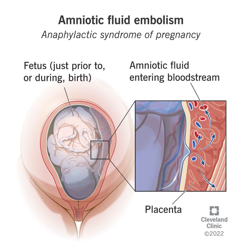 The inside of a uterus showing a fetus and amniotic fluid from the uterus crossing into the placenta and entering the bloodstream.