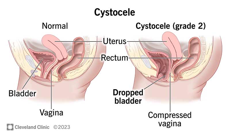 Healthcare providers group cystoceles into three grades. In a grade 2 cystocele, your bladder sinks to the opening of your vagina.