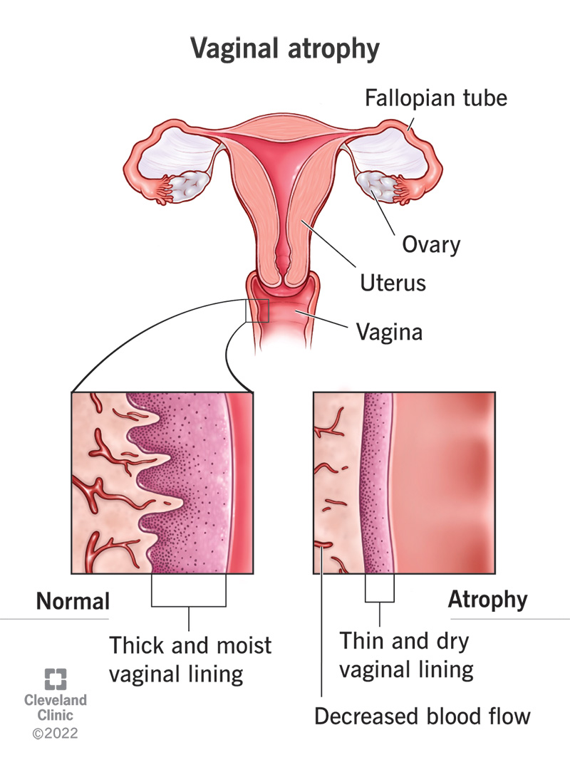 Comparison of a normal, thick and moist vaginal lining and a vaginal lining with atrophy, which appears thin and dry.