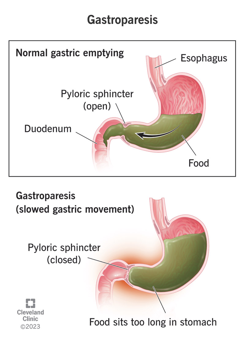  In gastroparesis, food doesn't move normally through your stomach.