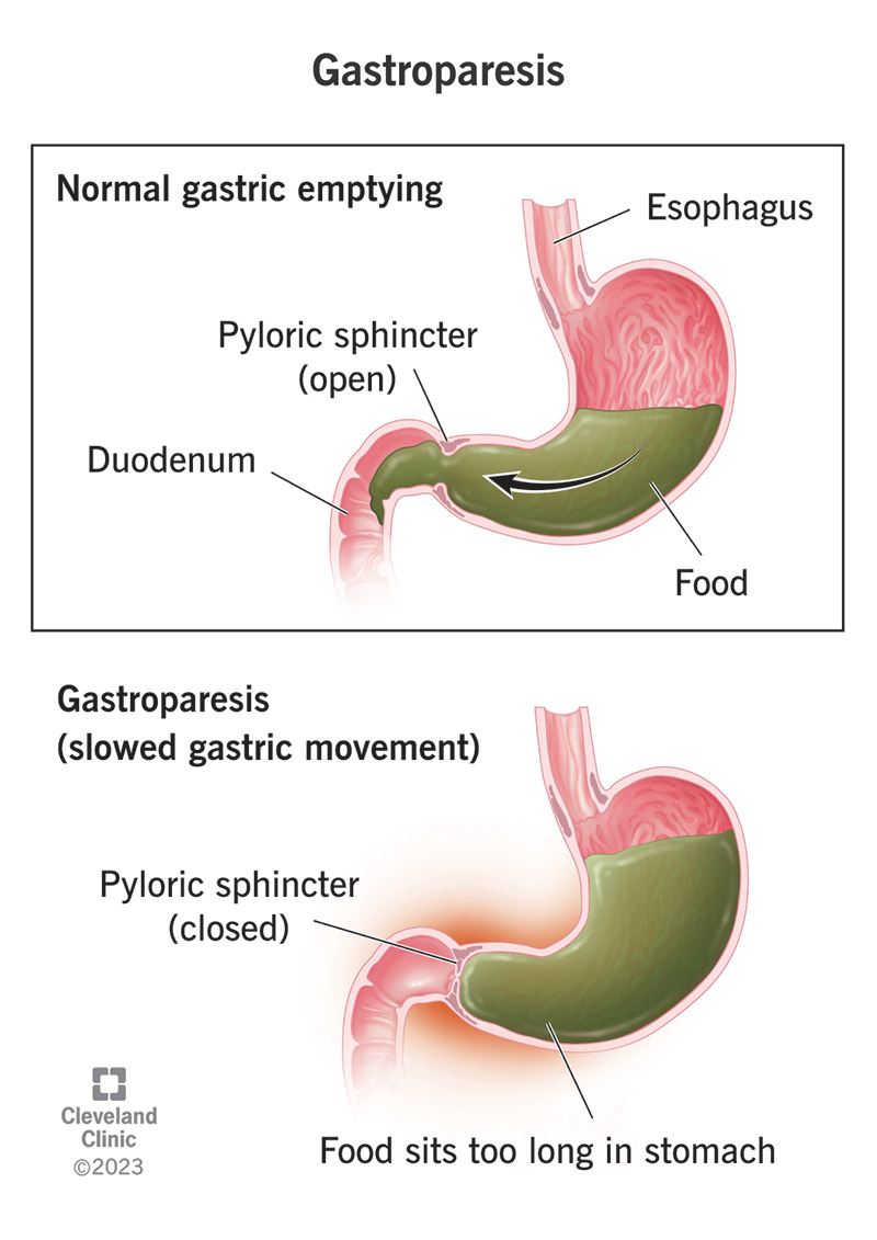 Gastroparesis Symptoms Causes Diagnosis Treatment