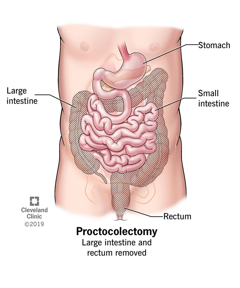 Proctocolectomy or removal of large intestine and rectum.