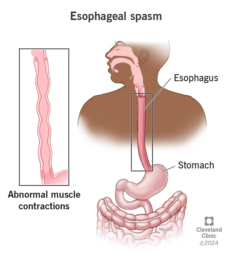 Abnormal muscle contractions within the esophagus