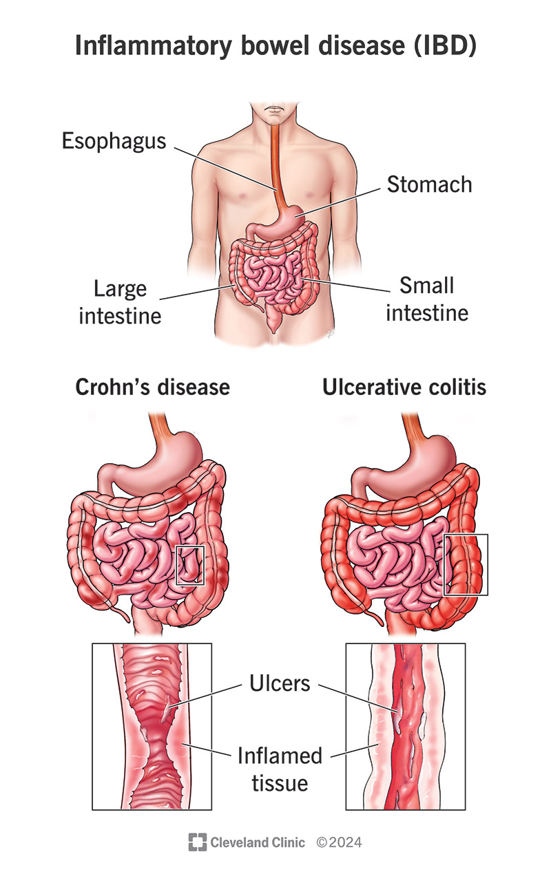 Раздраженный кишечник картинка. Bowel disease. Воспалительные заболевания кишечника. Хронические воспалительные заболевания жкт. Пищеварение фон.