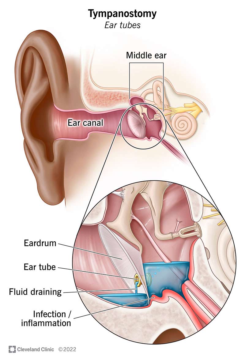 Tympanostomy (ear) tube draining fluid from the middle ear.