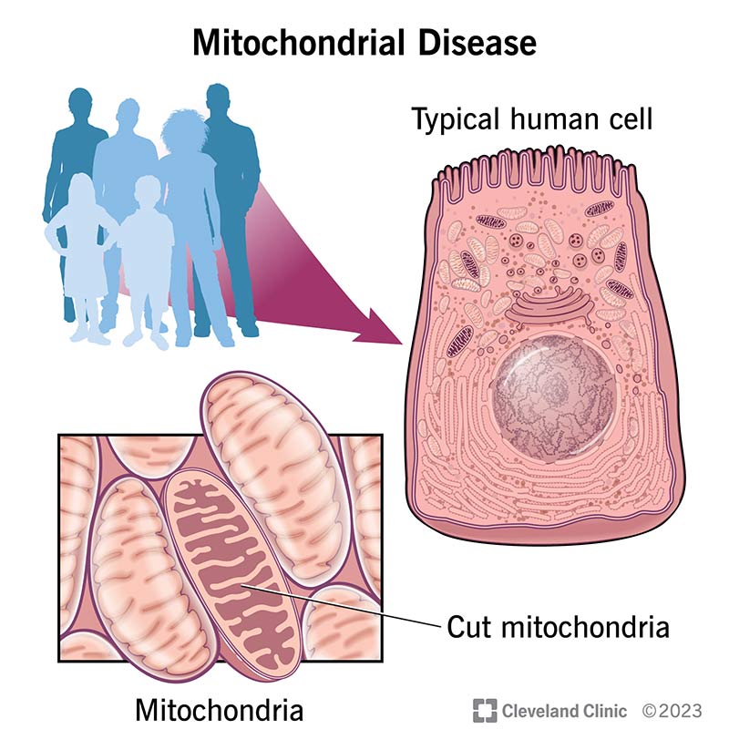A magnified mitochondria within a human cell affected by a mitochondrial disease.