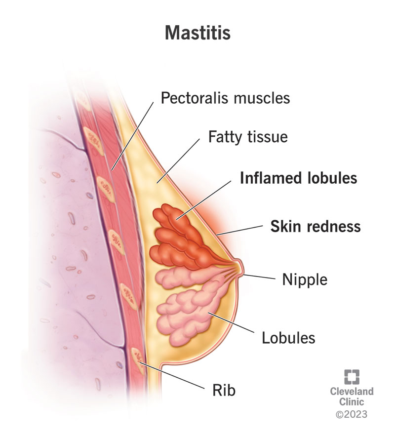 Breast anatomy showing skin redness due to inflamed lobules during mastitis infection.