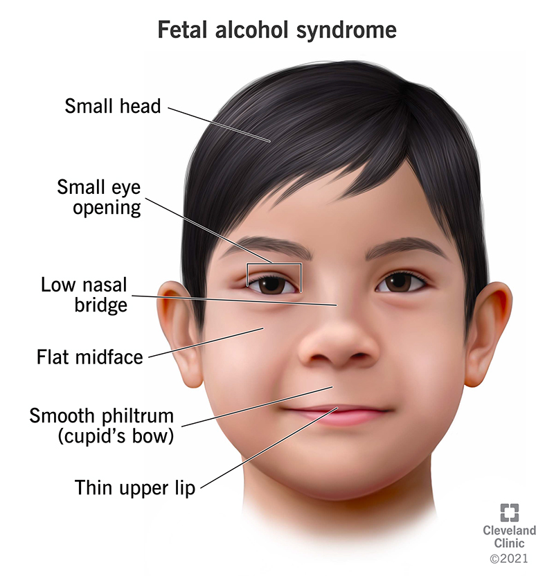 Child born with fetal alcohol syndrome (FAS) has distinct facial features