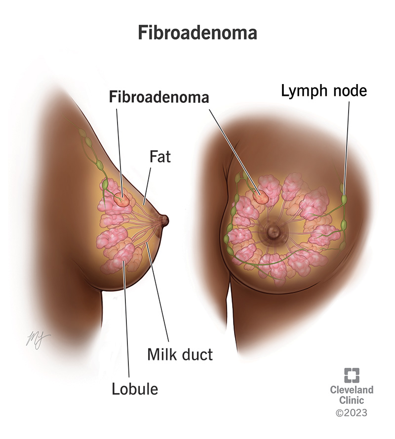 Breast anatomy showing milk ducts, muscles and a fibroadenoma lump.