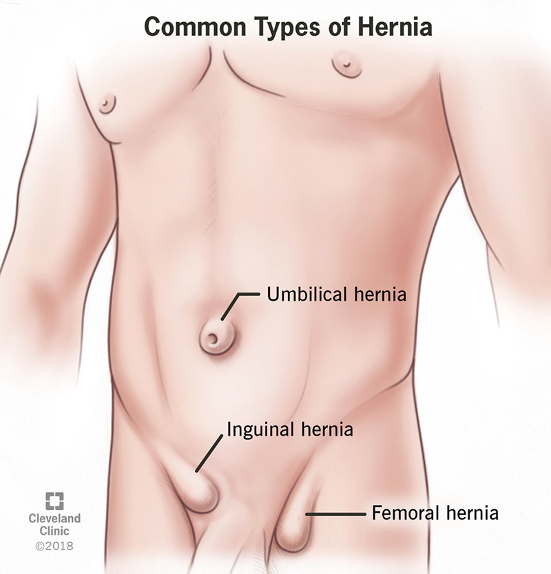 Common types of hernias include umbilical hernia, inguinal hernia and femoral hernia.