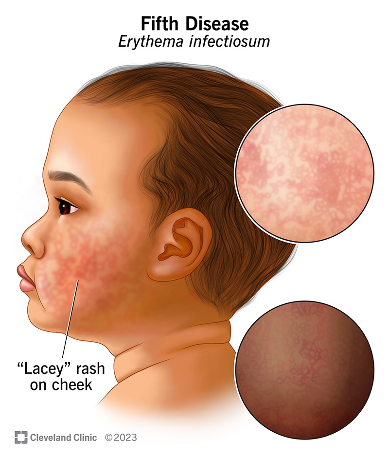 Illustration of a child with a lacey red rash on their cheek.