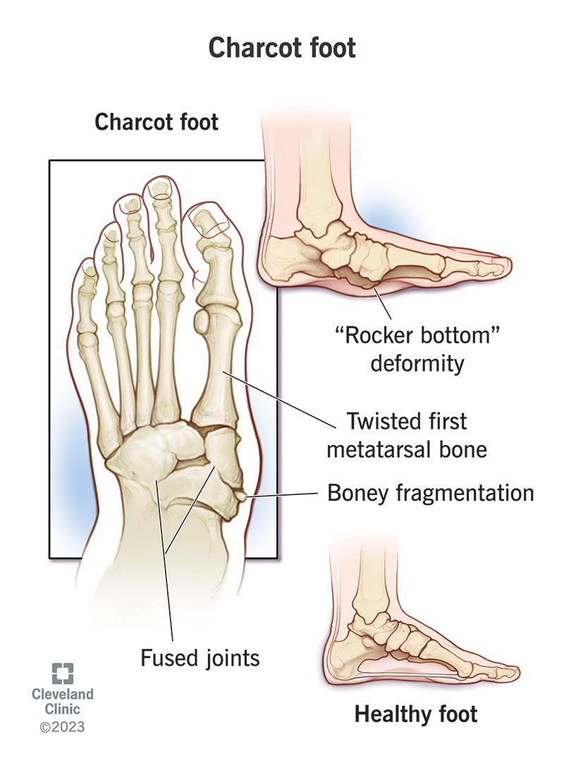 Charcot foot can cause severe complications if it's not treated right away.