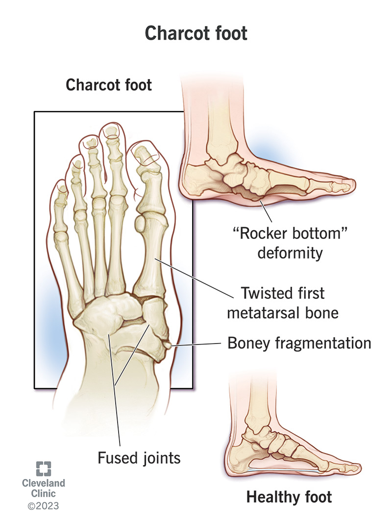 Charcot Foot: Symptoms, Causes & Treatment