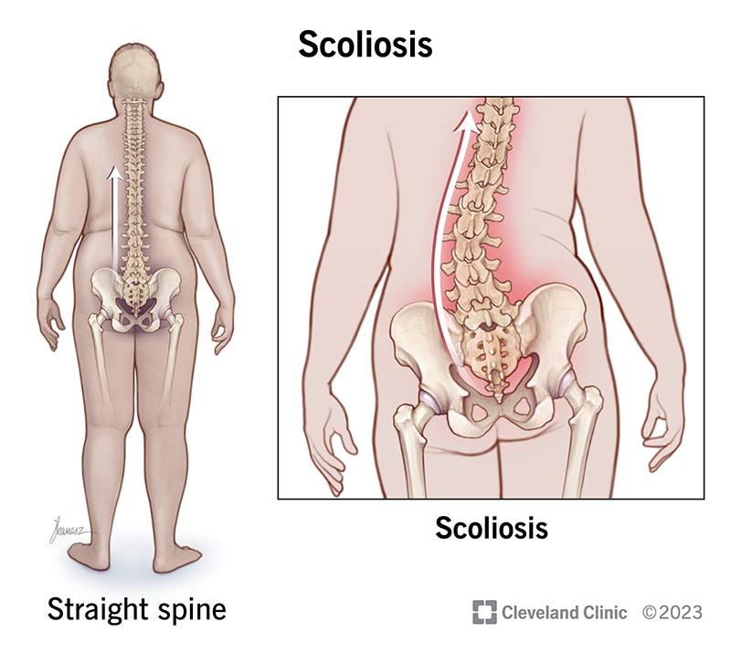 Do You Have a Curved Spine? The Three Most Common Spine Conditions