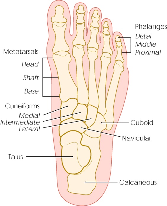 metatarsal bones fracture