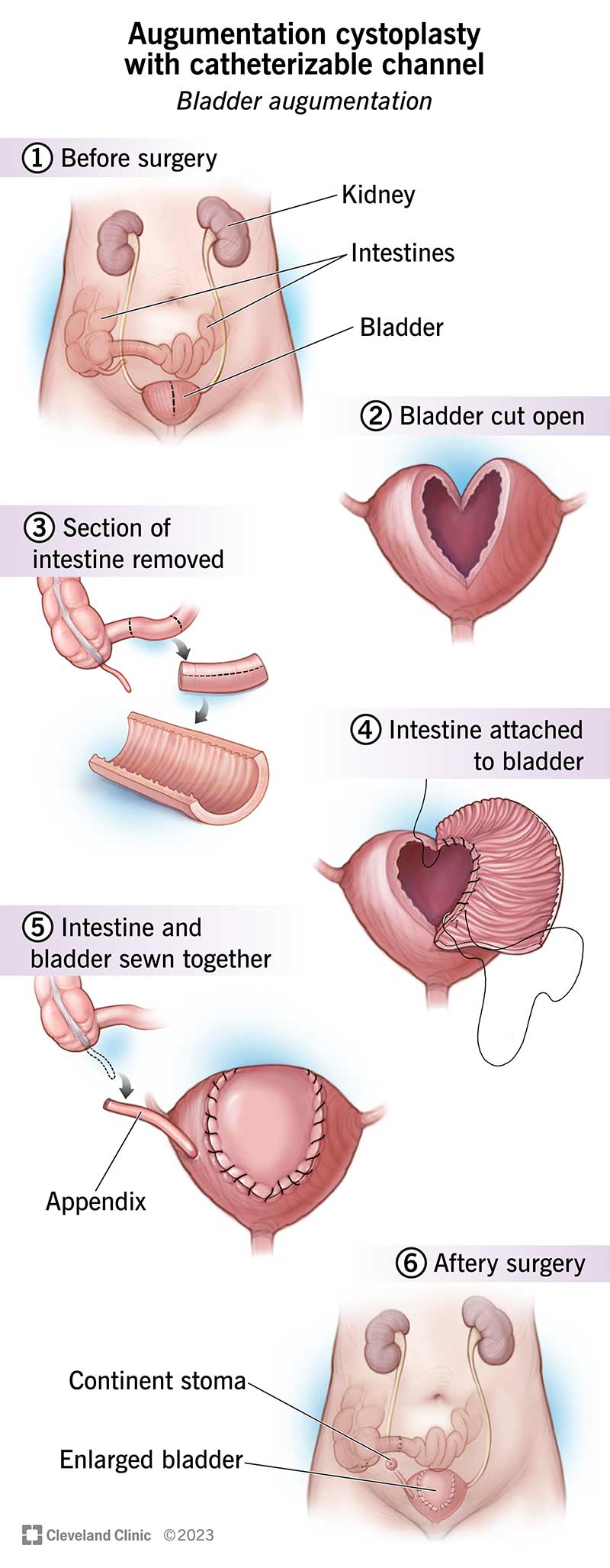 Abdominal organs before, during and after augmentation cystoplasty with catheterizable channel.